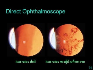30
Direct Ophthalmoscope
Red reflex ปกติ Red reflex ของผู้ป่ วยต้อกระจก
 