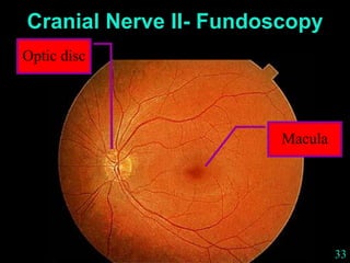 33
Macula
Optic disc
Cranial Nerve II- Fundoscopy
 