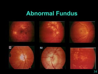 34
Abnormal Fundus
 
