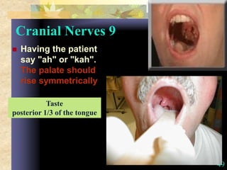 49
Cranial Nerves 9
 Having the patient
say "ah" or "kah".
The palate should
rise symmetrically
Taste
posterior 1/3 of the tongue
 