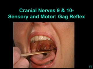 50
Cranial Nerves 9 & 10-
Sensory and Motor: Gag Reflex
 