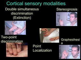60
Cortical sensory modalities
Two-point
discrimination
Graphesthesi
a
StereognosisDouble simultaneous
discrimination
(Extinction)
Point
Localization
 