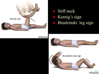  Stiff neck
 Kernig’s sign
 Brudzinski leg sign
65
 
