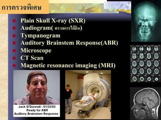 66
การตรวจพิเศษ
 Plain Skull X-ray (SXR)
 Audiogram( ตรวจการได้ยิน)
 Tympanogram
 Auditory Brainstem Response(ABR)
 Microscope
 CT Scan
 Magnetic resonance imaging (MRI)
 