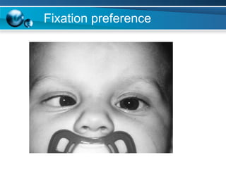 Fixation Preference Testing 2016 pgh basic pedia vision exam v2 | PDF