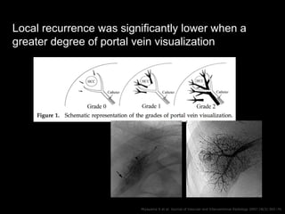 Local recurrence was significantly lower when a
greater degree of portal vein visualization
Miyayama S et al. Journal of V...