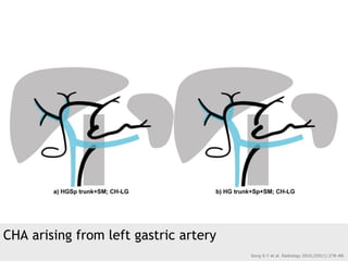 CHA arising from left gastric artery
Song S-Y et al. Radiology 2010;255(1):278–88.
 