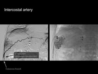 Intercostal artery
U-turn point
(diaphragm insertion site)
Cutaneous branch
 