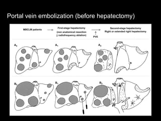 Portal vein embolization (before hepatectomy)
 