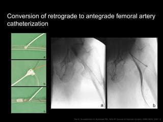 Conversion of retrograde to antegrade femoral artery
catheterization
Ysa A, Arruabarrena A, Bustabad MR, Peña M. Journal o...