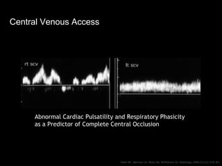 Central Venous Access
Patel MC, Berman LH, Moss HA, McPherson SJ. Radiology 1999;211(2):579–83.
Abnormal Cardiac Pulsatili...