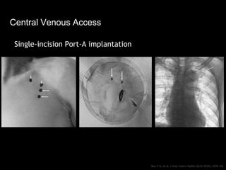 Central Venous Access
Seo T-S, et al. J Vasc Interv Radiol 2014;25(9):1439–46.
Single-incision Port-A implantation
 