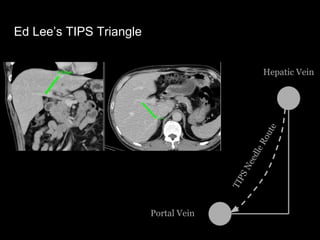 Ed Lee’s TIPS Triangle
Hepatic Vein
Portal Vein
TIPSNeedleRoute
 