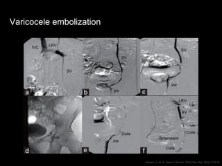 Varicocele embolization
Halpern J, et al. Asian J Androl. 2016 Mar-Apr;18(2):234-8.
 