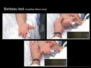 Barbeau test (modified Allen's test)
https://www.youtube.com/watch?v=GB07os7ZkAw
 