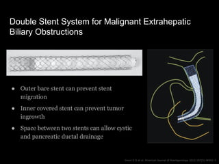 Double Stent System for Malignant Extrahepatic
Biliary Obstructions
Gwon Il D et al. American Journal of Roentgenology 201...
