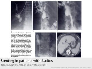 Stenting in patients with Ascites
Transjugular Insertion of Biliary Stent (TIBS)
Ring EJ, Gordon RL, LaBerge JM, Shapiro H...
