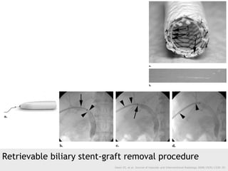 Retrievable biliary stent-graft removal procedure
Gwon DI, et al. Journal of Vascular and Interventional Radiology 2008;19...