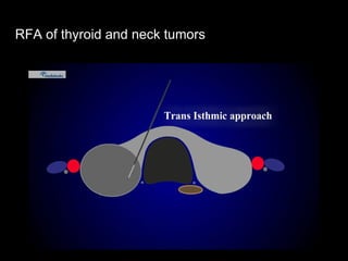 RFA of thyroid and neck tumors
 