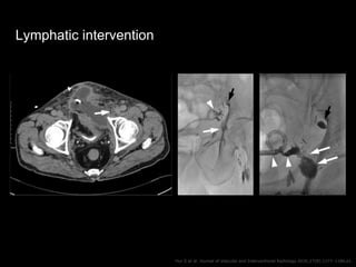 Lymphatic intervention
Hur S et al. Journal of Vascular and Interventional Radiology 2016;27(8):1177–1186.e1.
 