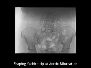 Shaping Yashiro tip at Aortic Bifurcation
 