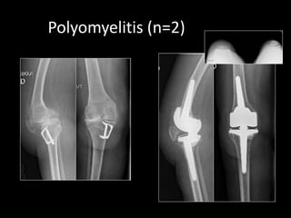 Polyomyelitis (n=2)
 