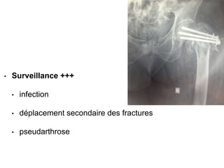 • Surveillance +++
• infection
• déplacement secondaire des fractures
• pseudarthrose
 