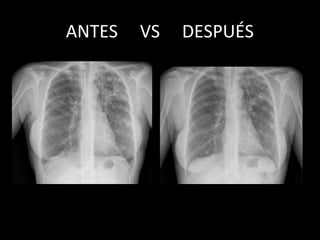 ANTES     VS     DESPUÉS
 