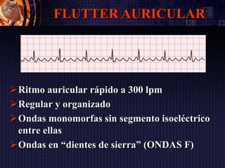 Ritmo auricular rápido a 300 lpm
Regular y organizado
Ondas monomorfas sin segmento isoeléctrico
entre ellas
Ondas en “dientes de sierra” (ONDAS F)
FLUTTER AURICULAR
 