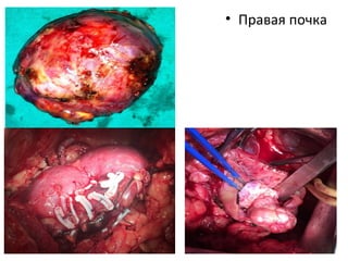 • Правая почка
 