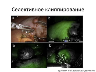 Селективное клиппирование
Bjurlin MA et al., EurUrol 2014;65:793-801
 