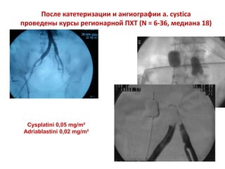 После катетеризации и ангиографии a. cystica
проведены курсы регионарной ПХТ (N = 6-36, медиана 18)
Cysplatini 0,05 mg/m²
Adriablastini 0,02 mg/m²
 
