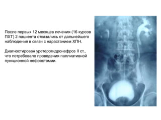 После первых 12 месяцев лечения (16 курсов
ПХТ) 2 пациента отказались от дальнейшего
наблюдения в связи с нарастанием ХПН.
Диагностирован уретерогидронефроз II ст.,
что потребовало проведения паллиативной
пункционной нефростомии.
 
