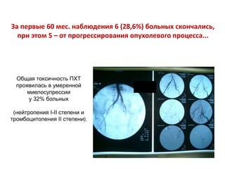 За первые 60 мес. наблюдения 6 (28,6%) больных скончались,
при этом 5 – от прогрессирования опухолевого процесса...
Общая токсичность ПХТ
проявилась в умеренной
миелосупрессии
у 32% больных
(нейтропения I-II степени и
тромбоцитопения II степени).
 
