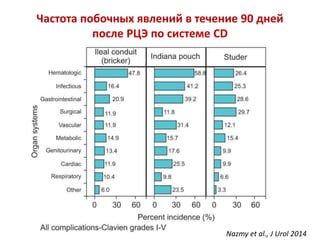Частота побочных явлений в течение 90 дней
после РЦЭ по системе CD
Nazmy et al., J Urol 2014
 
