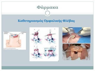 Φάρμακα
Καθετηριασμός Ομφαλικής Φλέβας
 