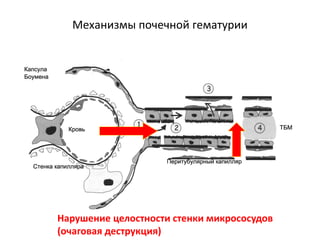 Механизмы почечной гематурии
Нарушение целостности стенки микрососудов
(очаговая деструкция)
 