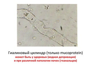 Гиалиновый цилиндр (только mucoprotein)
может быть у здоровых (водная депривация)
и при различной патологии почек (>канальцев)
 