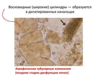 Восковидные (широкие) цилиндры ― образуются
в дилатированных канальцах
Атрофические тубулярные изменения
(поздние стадии дисфункции почек)
 