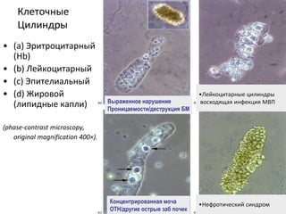 Клеточные
Цилиндры
• (a) Эритроцитарный
(Hb)
• (b) Лейкоцитарный
• (c) Эпителиальный
• (d) Жировой
(липидные капли)
(phase-contrast microscopy,
original magnification 400×).
•Лейкоцитарные цилиндры
восходящая инфекция МВП
Концентрированная моча
ОТН/другие острые заб почек
Выраженное нарушение
Проницаемости/деструкция БМ
•Нефротический синдром
 
