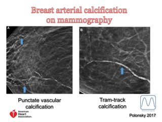 carlomaggio.it
Punctate vascular
calcification
Tram-track
calcification
Polonsky 2017
 