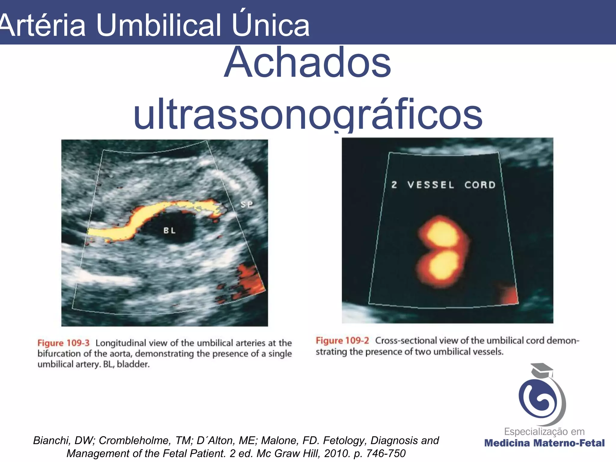Artéria Umbilical Única - Mariana Rialto | PPT | Download Gratuito