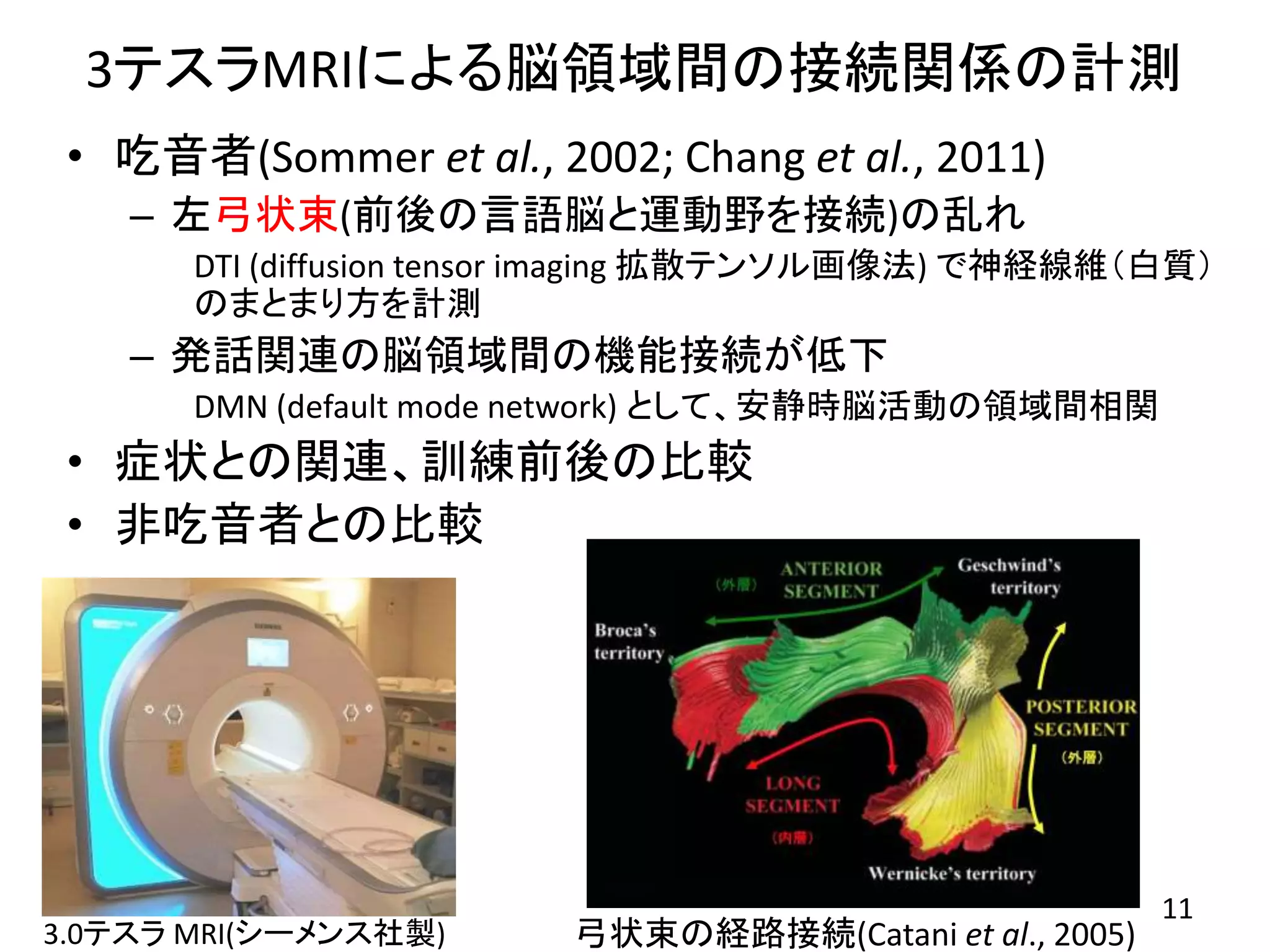 3テスラMRIによる脳領域間の接続関係の計測
• 吃音者(Sommer et al., 2002; Chang et al., 2011)
– 左弓状束(前後の言語脳と運動野を接続)の乱れ
DTI (diffusion tensor imaging 拡散テンソル画像法) で神経線維（白質）
のまとまり方を計測
– 発話関連の脳領域間の機能接続が低下
DMN (default mode network) として、安静時脳活動の領域間相関
• 症状との関連、訓練前後の比較
• 非吃音者との比較
3.0テスラ MRI(シーメンス社製) 弓状束の経路接続(Catani et al., 2005)
11
 