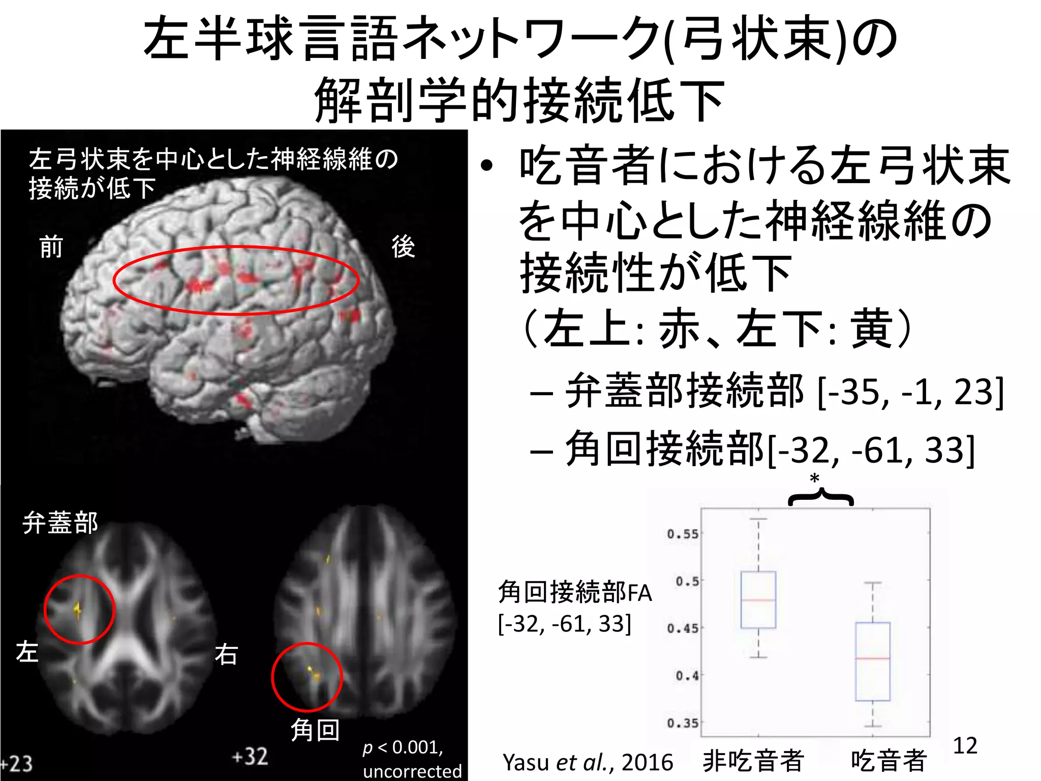 左半球言語ネットワーク(弓状束)の
解剖学的接続低下
• 吃音者における左弓状束
を中心とした神経線維の
接続性が低下
（左上: 赤、左下: 黄）
– 弁蓋部接続部 [-35, -1, 23]
– 角回接続部[-32, -61, 33]
p < 0.001,
uncorrected
左 右
前 後
12
角回接続部FA
[-32, -61, 33]
非吃音者 吃音者
弁蓋部
角回
左弓状束を中心とした神経線維の
接続が低下
*
{Yasu et al., 2016
 