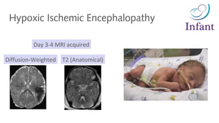 Hypoxic Ischemic Encephalopathy
Day 3-4 MRI acquired
Diffusion-Weighted T2 (Anatomical)
 