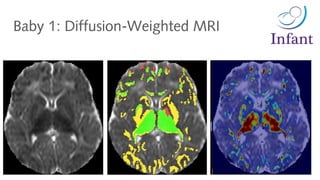 Baby 1: Diffusion-Weighted MRI
 