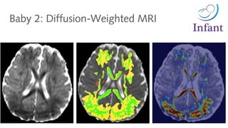 Baby 2: Diffusion-Weighted MRI
 