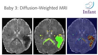 Baby 3: Diffusion-Weighted MRI
 