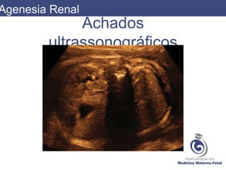 Achados
ultrassonográficos
Agenesia Renal
 