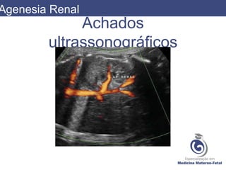 Achados
ultrassonográficos
Agenesia Renal
 